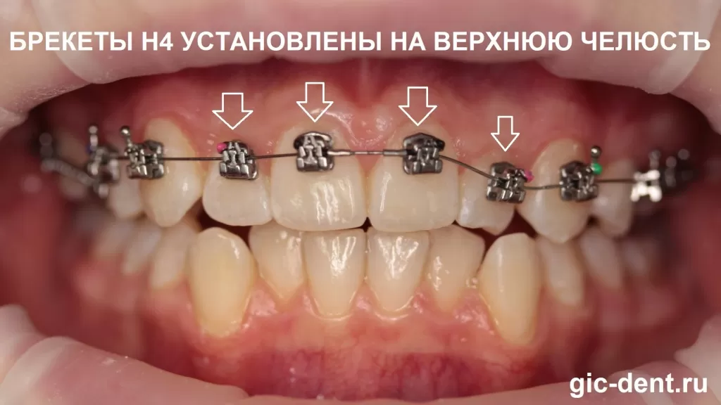 Фото начальное с установленными брекетами h4 на зубах верхней челюсти ребенка
